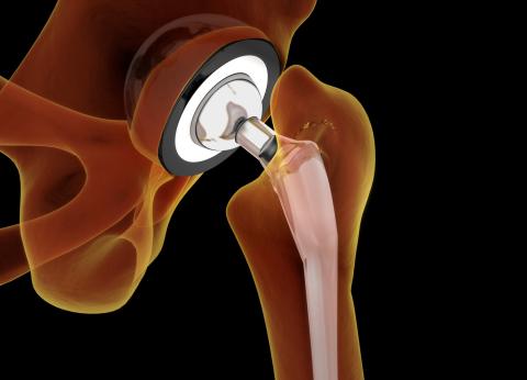 hip replacement