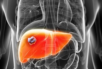 X-ray of liver disease
