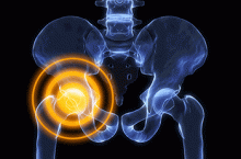 A pelvic X-ray with emphasis on the hip