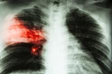 A chest X-ray of a patient with tuberculosis