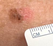 Clinical example of an elliptical biopsy with 1–3 mm clinical margins.