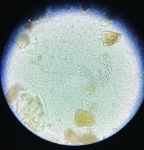 Strongyloides stercoralis larvae detected by stool microscopy.