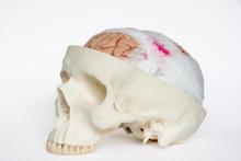 Exposed brain in a skull wrapped in bandages