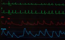 close up monitor showing atrial fibrillation