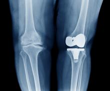 Osteoarthritis Knee ( OA Knee ) comparison on left arthroplasty / total knee replacement show metallic joint implant in bone and right knee Osteoarthritis show in front view