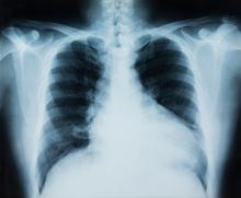 X ray of a lung with the right side filled with air