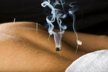 Acupuncture patient with moxa burning herbs atop of needles