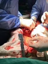 Organ transplantation surgery