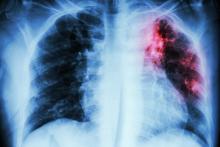 X-ray of pulmonary tuberculosis
