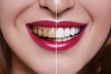 Woman Teeth before and after dental treatment. Teeth Whitening.